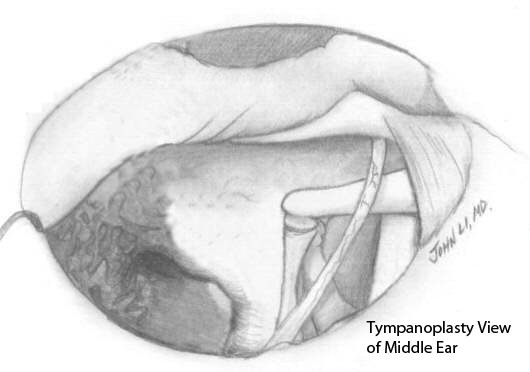 Tympanoplasty