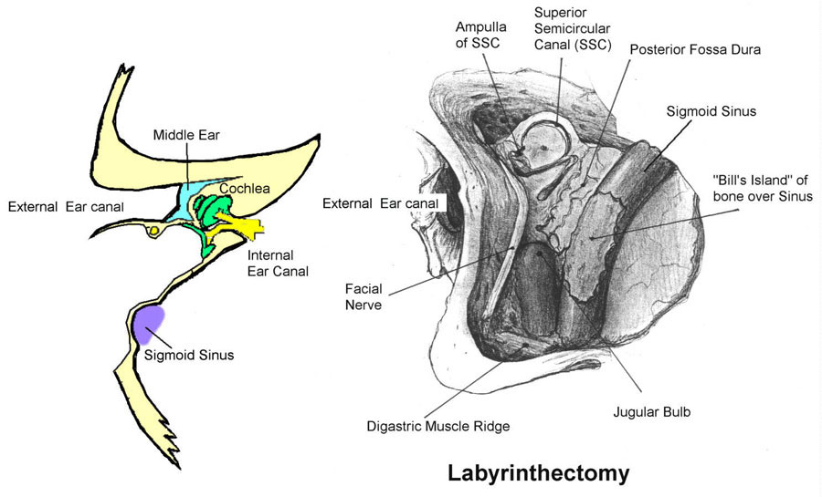Labyrinthectomy